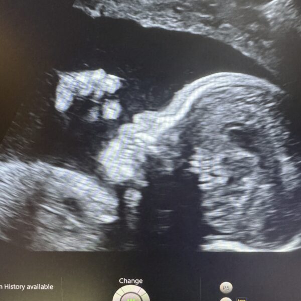 2D ultrasound image of a baby